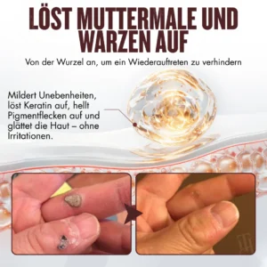 Offizieller Store | Schluss mit brennenden Säuren! Entfernen Sie Hautmakel sanft & sicher RZXEA™ All-in-1 Ceramide Hautcreme